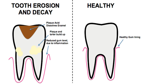 Diagram_of_tooth_erosion.png