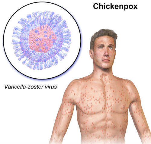 800pxChickenpox.png