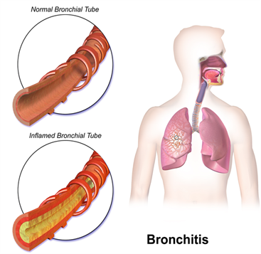 646px-Bronchitis.png