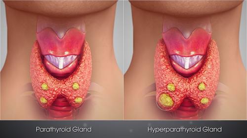 1024px-3D_Medical_Animation_still_shot_Hyperparathyroidism.jpg
