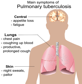 524px-Pulmonary_tuberculosis_symptoms.png