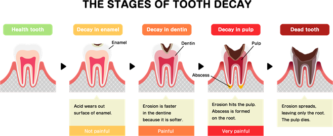 Tooth decay_Shutterstock.png