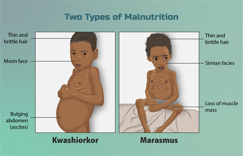 Depiction_of_children_suffering_from_two_types_of_malnutrition.png