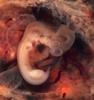 Tubal_Pregnancy_with_embryo.jpg