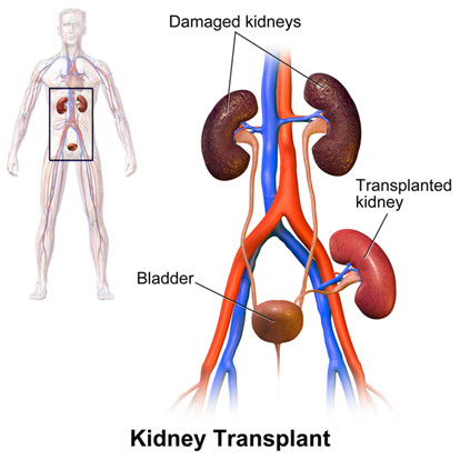 600px-Kidney_Transplant.png