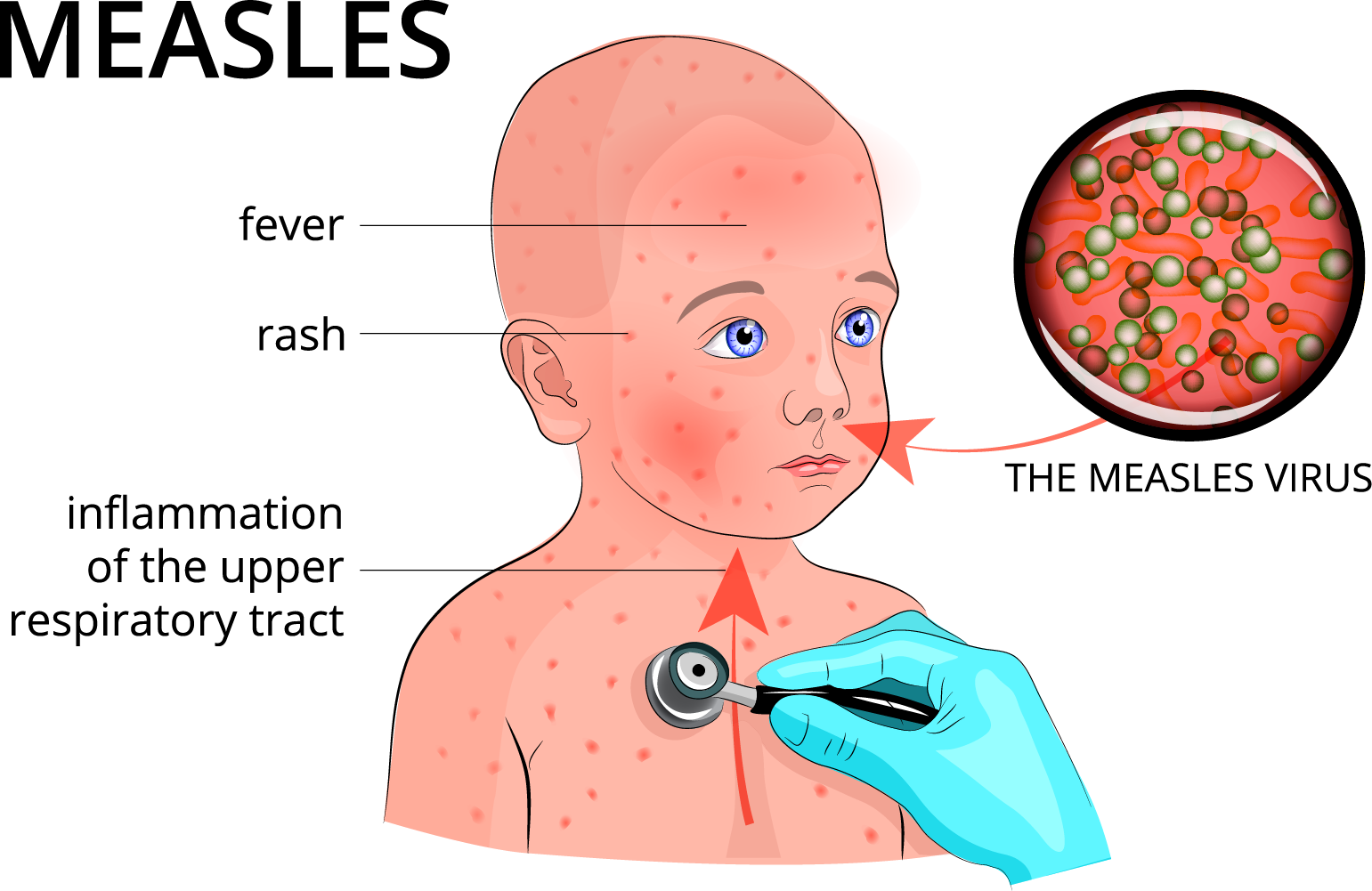 Airborne diseases caused by virus — lesson. Science State Board, Class 9.