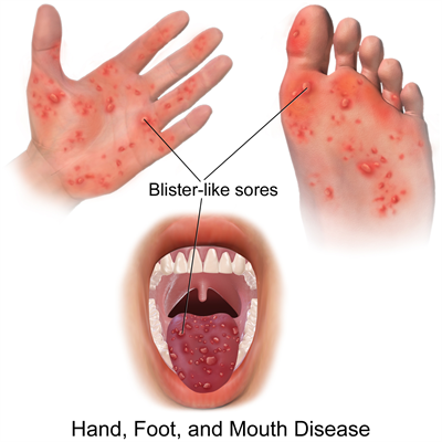 Hand_Foot_&_Mouth_Disease.png