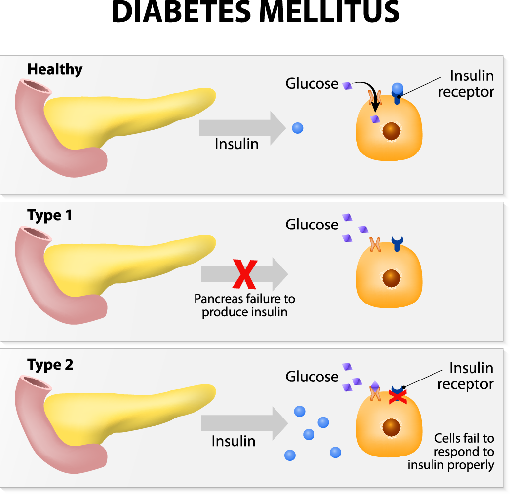 prevention-and-control-of-diabetes