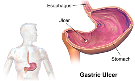 800px-Gastric_Ulcer.png