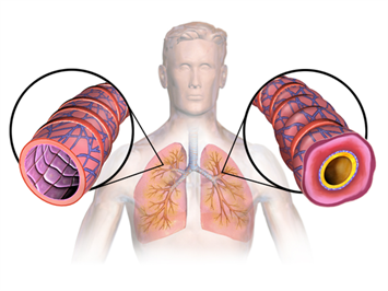 512px-Asthma_(Lungs).png