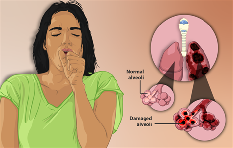 800px-Depiction_of_a_woman_suffering_from_Emphysema,_a_type_of_Chronic_Obstructive_Pulmonary_Disease.png