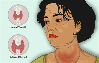 800px-A_woman_suffering_from_Goiter.png