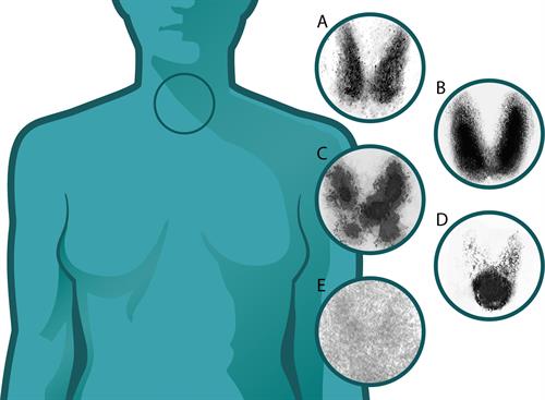 Thyroid_scintigraphy.jpg
