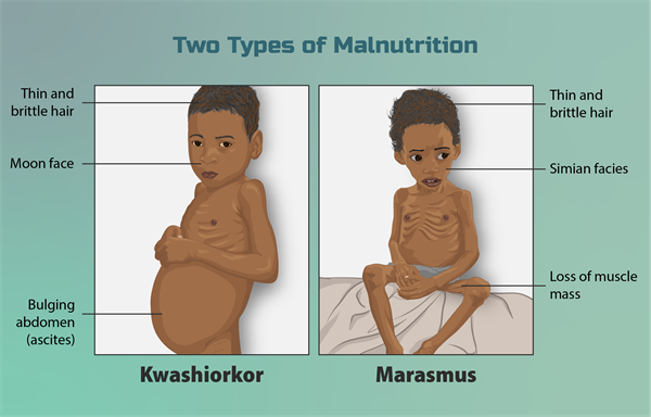 Depictionofchildrensufferingfromtwotypesofmalnutrition.png