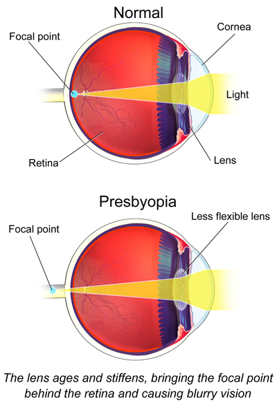 400px-Presbyopia.png